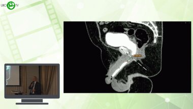 Шкодкин С.В. - Анастомотическая пластика задней уретры с адаптацией кавернозных тел