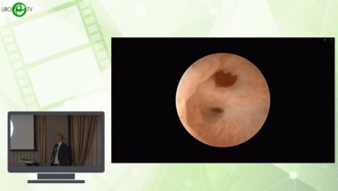 Шкодкин С.В. - Этапная пластика уретры - для кого?