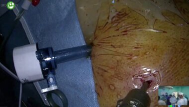 Панфёров А.С. - Лапароскопическая простатэктомия