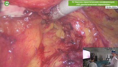 Орлов И.Н. -  Olympus Visera Elite. Лапароскопическая аденомэктомия