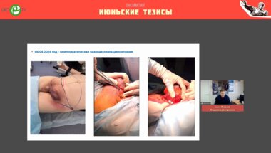 Яковлев В.Д. - Рак полового члена - когда можно сохранить анатомию и функцию?