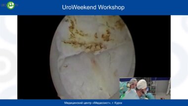 Дымов А.М. - HoLEP