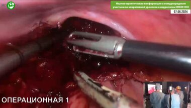 Мишугин С.В - Лапароскопическая цистпростатэктомия