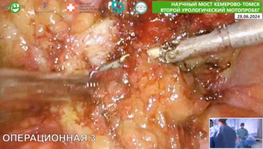 Новиков А.Б. - Лапароскопическая YV-пластика склероза шейки МП