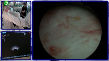 ТУ энуклеация аденомы простаты под УЗИ-контролем