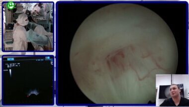 Еременко А.Н. - Трансуретральная лазерная энуклеация аденомы простаты под УЗИ-контролем