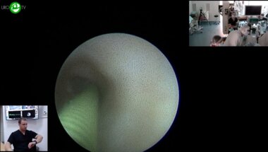 Еременко А.Н. - Перкутанная нефролитотрипсия с литоэкстракцией, стентирование