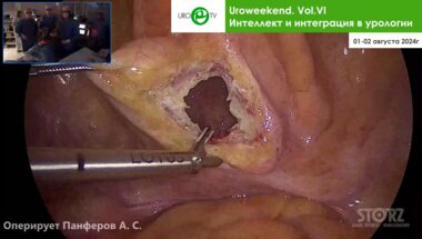 Панферов А.С., Стригунов А.А. - Лапароскопическая трансвезикальная аденомэктомия