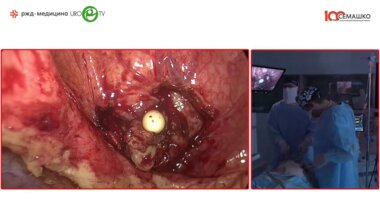 Кочкин А.Д., Кнутов А.В. - Лапароскопическая трансвезикальная аденомэктомия