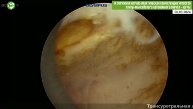 Дымов А.М. - Трансуретральная лазерная энуклеция аденомы простаты