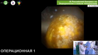 Григорьев Н.А. - RIRS. Ретроградная лазерная нефролитотрипсия (лазер Urolase)