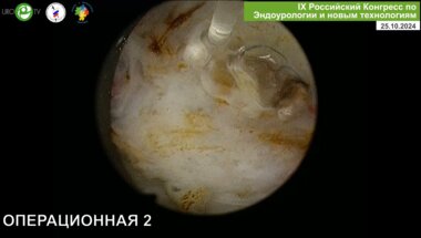 Бурлака О.О. - Лазерная энуклеация простаты