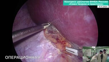 Перепечай В.А. - Лапароскопическая резекция почки с ICG