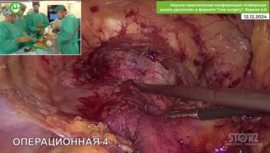 Рева С.А. - Лапароскопическая радикальная простатэктомия