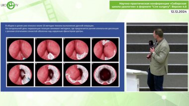 Гоняев А.Р. - Техника гольмиевой энуклеации аденомы ПЖ. Что менялось. Анализ 1000 клинических случаев