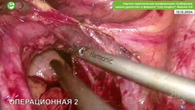 Галлямов Э.А. - Пластика н/3 правого мочеточника