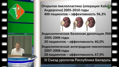 Дубров В.И. - Результаты применения лапароскопической пиелопластики при гидронефрозе у детей.  