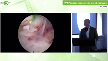 Бадьян К.И. -  Лазерная энуклеация простаты единым блоком