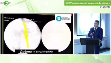 Медведев П.Е. - Лапароскопическая нефруретерэктомия при раке мочеточника с расширенной лимфаденэктомией