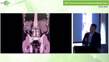 Медведев П.Е. - Особенности билатеральной нефрэктомии при поликистозе почек (суммарный объем 15 кг)