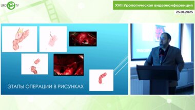 Оччархаджиев С.Б. - Конверсия континентной кишечной уродеривации