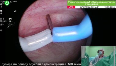 Орлов И.Н.  - Olympus Plasma и биполярная ТУР мочевого пузыря по поводу опухоли с демонстрацией NBI технологии