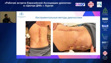 Безруков Е.А. - Лапароскопия и спаечный процесс в брюшной полости. Варианты преодоления осложнений