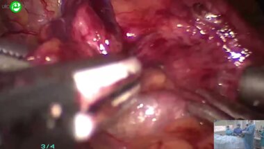 Безруков Е.А. - Лапароскопическая простатэктомия с тазовой лимфаденэктомией