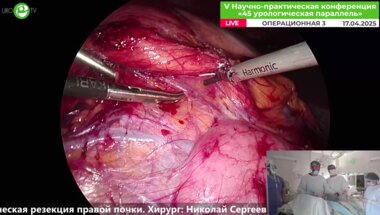 Тен Н.С. - Лапароскопическая резекция правой почки