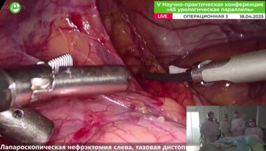 Кочетов А.Г. - Лапароскопическая нефрэктомия слева, тазовая дистопия, гидронефроз