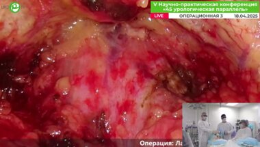 Орлов И.Н. - Лапароскопическая аденомэктомия (объем простаты 250 куб.см.)