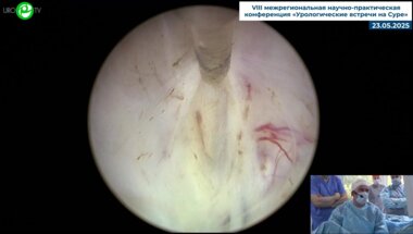 Гоняев А.Р. - Лазерная гольмиевая энуклеация предстательной железы (лазер MuitiPulse Ho)