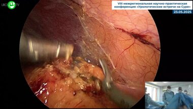 Миронов М.А. - Лапароскопическая резекция почки с использованием ультразвуковых ножниц EsyUS