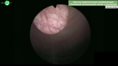 Суханов Р.Б. - Лазерная энуклеация гиперплазии простаты total en bloc