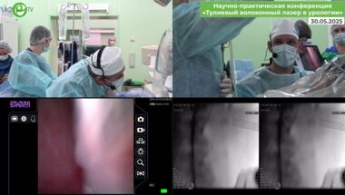 Акопян Г.Н., Панферов А.С. Эндоскопическая комбинированная интраренальная хирургия