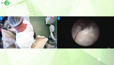 Лавинский Р.В. - Биполярная энуклеация гиперплазии простаты Би-ТУЭП