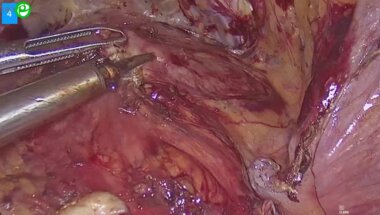 Панфёров А.С. - Лапароскопическая пластика мочеточника