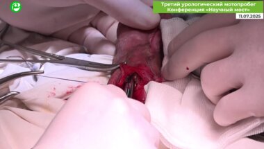 Кызласов П.С. - Фаллоэндопротезирование