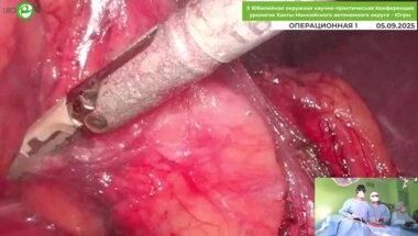 Орлов И.Н. - Olympus Visera 3D-лапароскопическая резекция мочеточника по поводу стриктуры лоханочно-мочеточникового сегмента