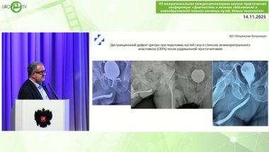 Живов А.В. - Анастомотическая уретропластика. Выбор доступа