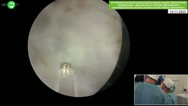 Кочетов А.Г. - Лазерная энуклеация аденомы простаты MiLEP с Fiberlase U–MAX