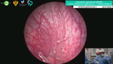 Мартов А.Г. - Трансуретральная биполярная резекция опухоли мочевого пузыря с PDD на Safira