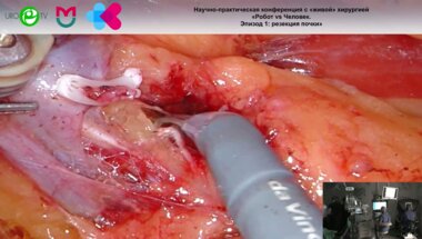 Котов С.В. - Робот-ассистированная резекция почки