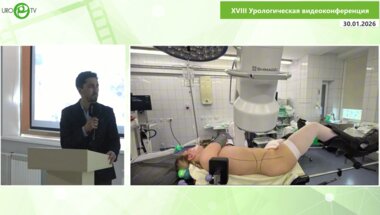 Аллахвердиев О.Н. - Хирургическое лечение фиброэпителиальных полипов верхних мочевых путей больших размеров