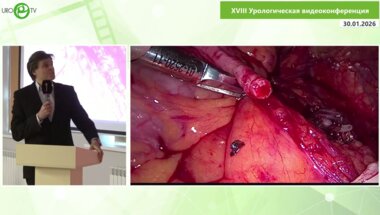 Волков С.Н. - Лапароскопическая пластика нижней трети мочеточника аппендикулярным отростком