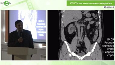 Иванов К.В. - Лапароскопическая пластика гидронефроза справа на мочеточниковом стенте по Хайнсу-Андерсону