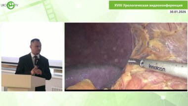 Опольский А.М., Рагимов К.А., Левонян А.Г. - Лапароскопическая аугментационная буккальная onlay пластика верхней трети левого мочеточника с фибропиелолитоэкс