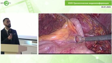 Левонян А.Г. - Лапароскопическая заместительная аппендикулярная пластика верхней трети правого мочеточника