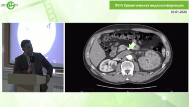 Лысёнок А.Ю. - Лапароскопическая резекция тромба нижней полой вены при раке левой почки
