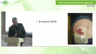 Сысоев А.М. - Лапароскопическая пексия илеокондуита, ушивание дефекта передней брюшной стенки